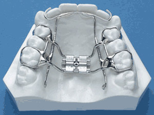 Orthodontic Expanders in the Atlanta Area- Family Orthodontics GA