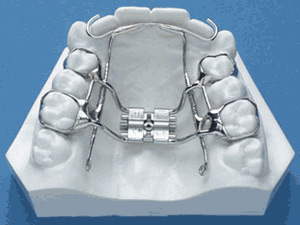 Palatal Expander-NW Washington DC Orthodontist